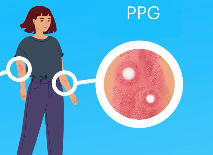 Psoriasis Pustulosa Generalizada (PPG) 