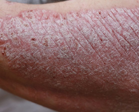 imagem-guia-psoriase-latam