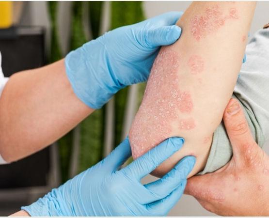 psoriasis-systemic-treatment